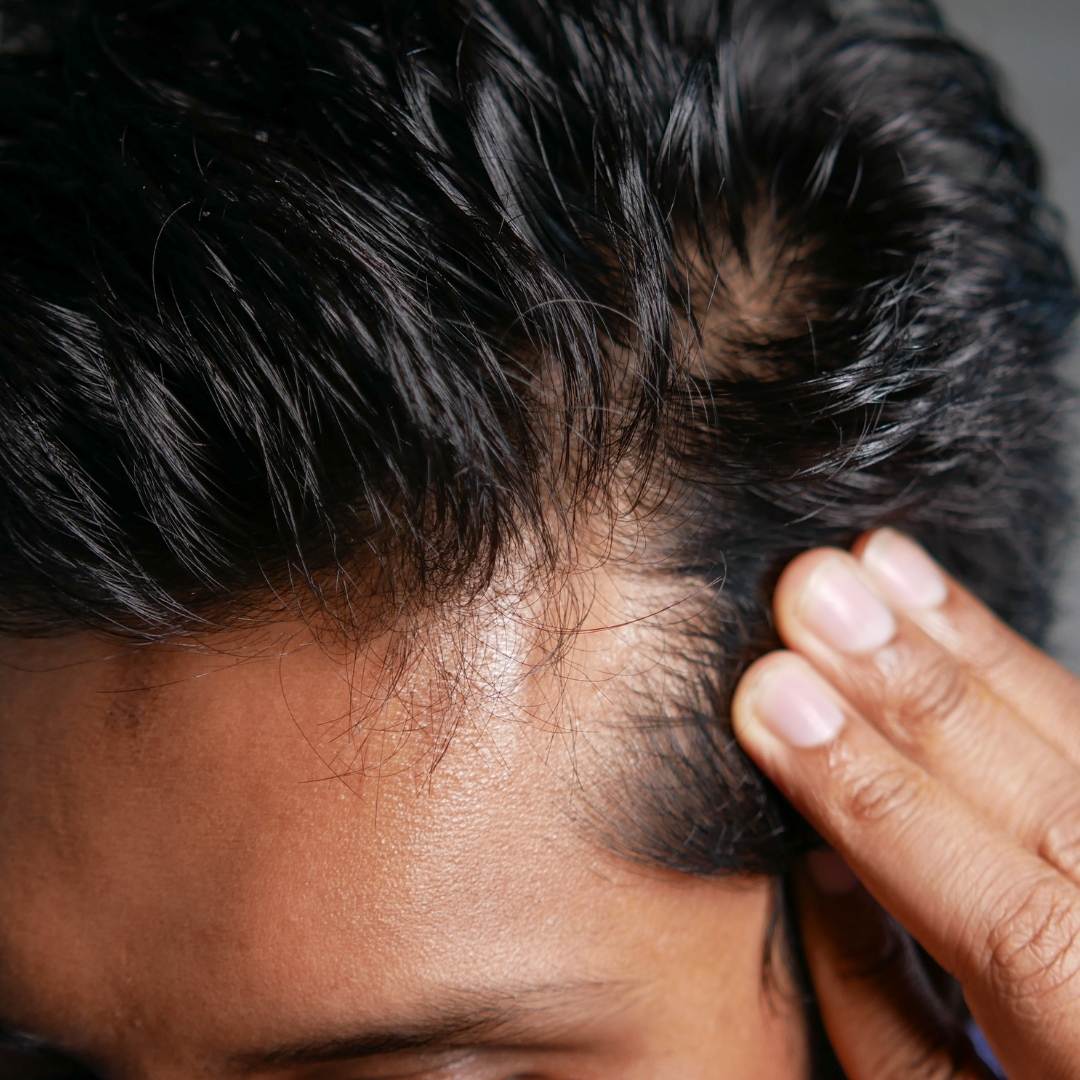 La deficiencia de zinc puede provocar la caída del cabello