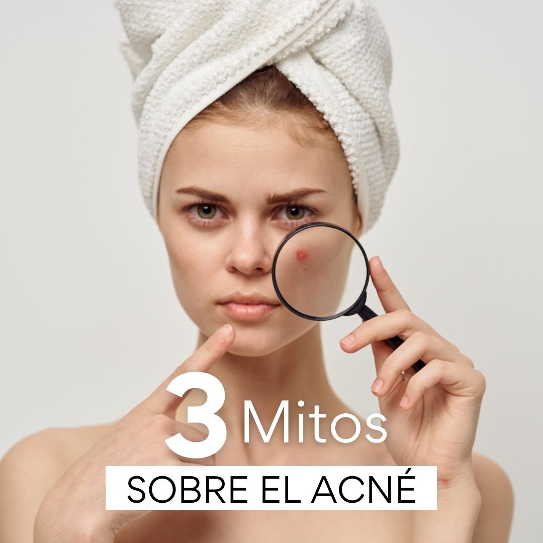 3 Mitos sobre el acné