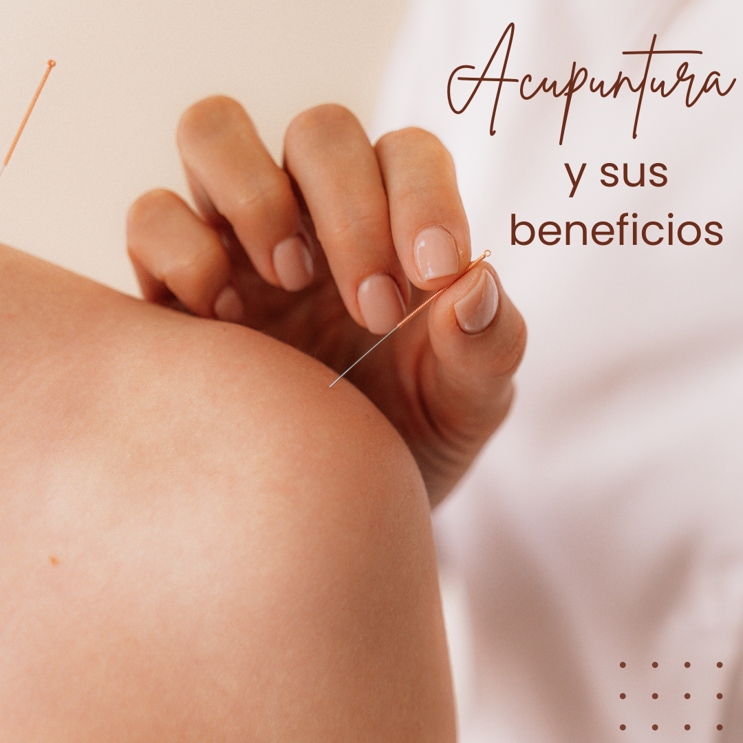 Beneficios de la acupuntura