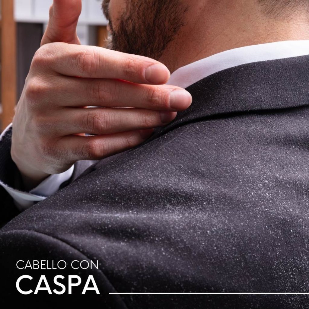 Tipos de caspa y tratamientos