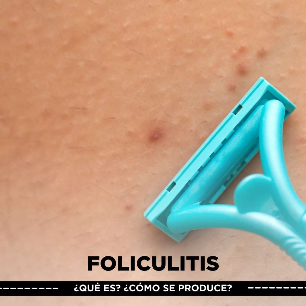 Foliculitis: qué es y cómo se produce