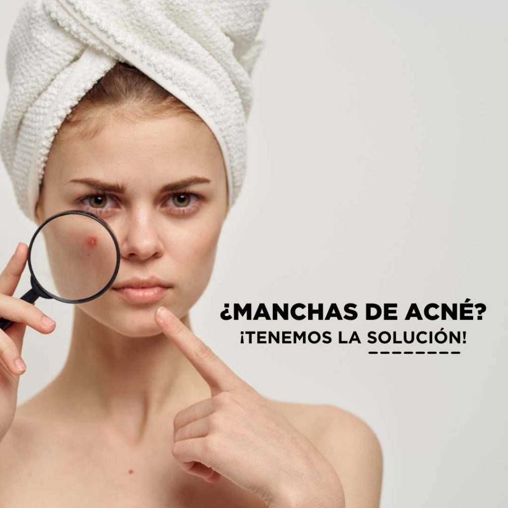 Solución a las manchas de acné